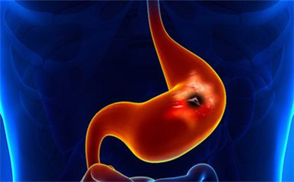 急性单纯性胃炎有哪些症状?急性单纯性胃炎有