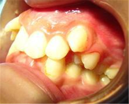 乳牙滞留的病因有哪些