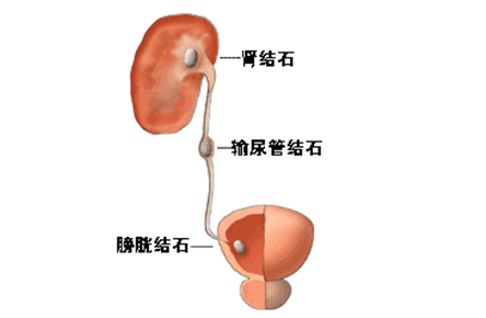 输尿管结石症状 输尿管结石的治疗方法
