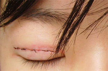埋线双眼皮能保持多久 术后护理很重要