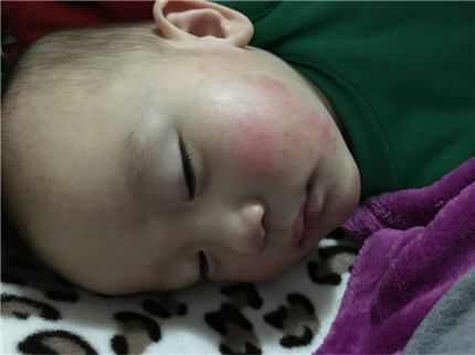 宝宝的高发病湿疹：婴儿湿疹会有哪些危害呢?