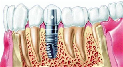 什么是种植牙齿?种植牙齿的好处和危害都有哪些?