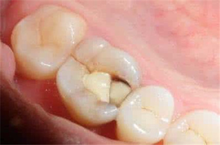 蛀牙要怎么治疗?怎么预防蛀牙的出现?