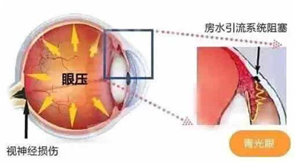 青光眼的症状有哪些?青光眼可以治得好吗?