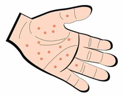 手足口病的症状有哪些?手足口病怎么治疗和预防?