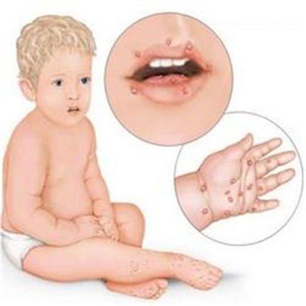 手足口病的症状有哪些?手足口病怎么治疗和预防?