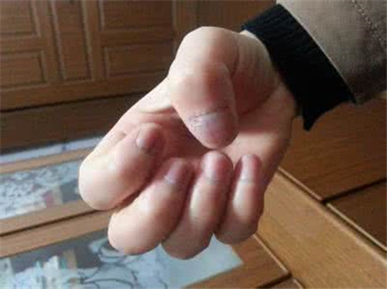 灰指甲的初期症状有哪些?引起灰指甲的原因是什么?