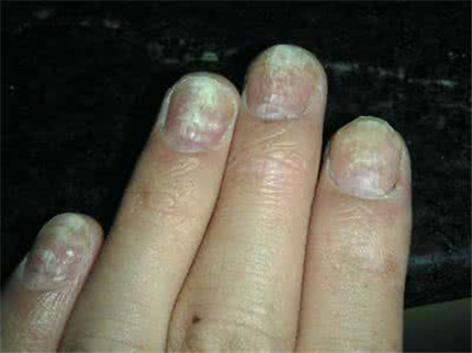 灰指甲的初期症状有哪些?引起灰指甲的原因是什么?