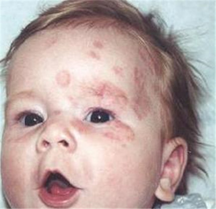 红斑狼疮是什么病?红斑狼疮有哪些早期症状?