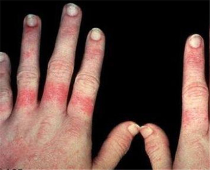 红斑狼疮是什么病?红斑狼疮有哪些早期症状?