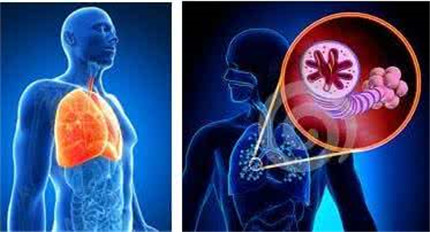 肺气肿的原因有哪些?肺气肿有哪些症状?