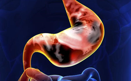 胃癌早期症状有哪些?日常生活中如何预防胃癌