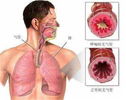 支气管炎有哪些症状?支气管炎应该怎么办?