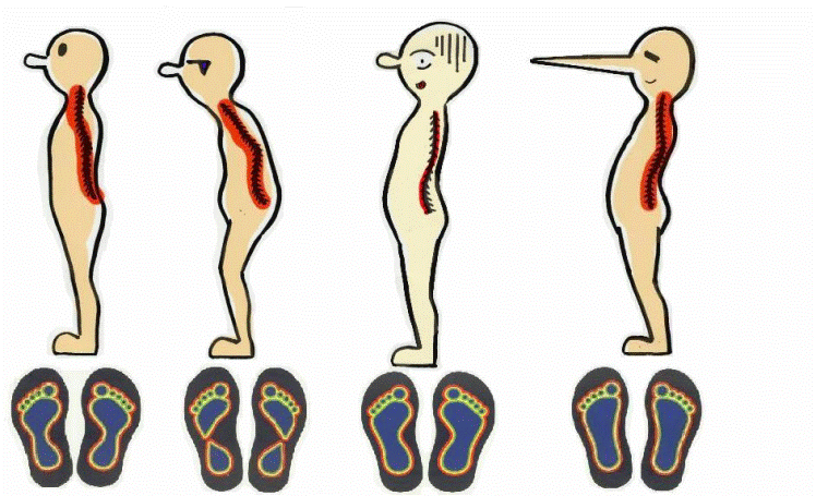 什么是高弓足?高弓足的症状和危害有哪些?
