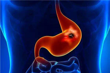 胃病的早期症状有哪些?引发胃病的原因有哪些?