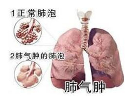 老年人肺气肿有哪些危害?老年人肺气肿可以治得好吗?