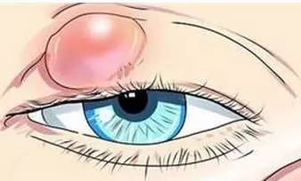 为什么会长针眼?9大方法教你如何预防长针眼