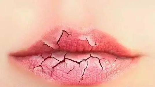 夏季嘴唇干裂是什么原因?推荐几个护唇小妙招