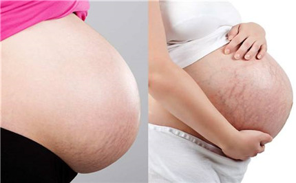 妊娠纹什么时候开始出现的?如何有效防止妊娠纹?