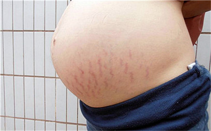 妊娠纹什么时候开始出现的?如何有效防止妊娠纹?