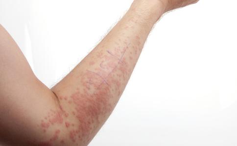 胆碱能性荨麻疹的成因有哪些?预防胆碱能性荨麻疹的六大注意事项
