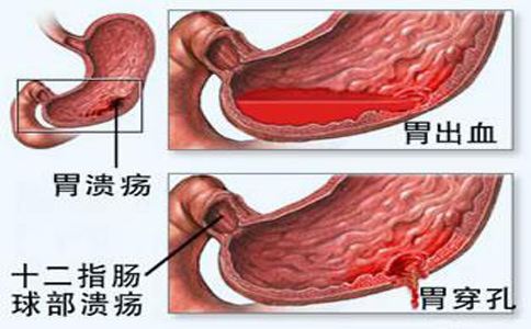 胃出血的危害有哪些?胃出血的5大调理方法