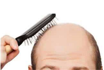 男性脱发的原因有哪些?男性脱发怎么办?