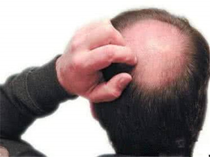 男性脱发的原因有哪些?男性脱发怎么办?