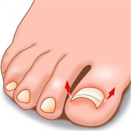 脚大拇指甲沟炎有哪些症状?脚大拇指甲沟炎怎么办?