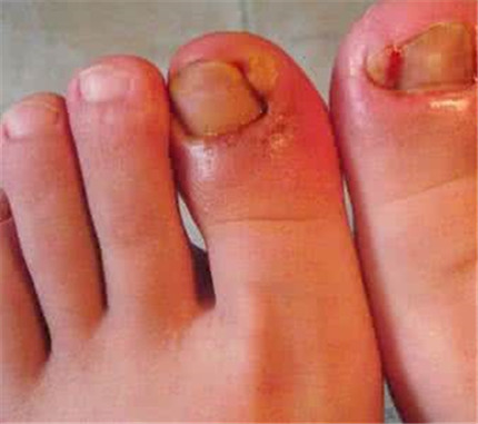 脚大拇指甲沟炎有哪些症状?脚大拇指甲沟炎怎么办?