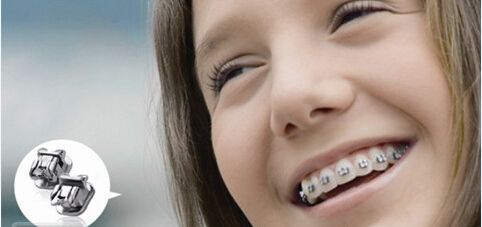 戴牙套前须知的10大注意事项 戴牙套好处是什么?