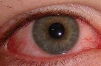 眼角膜发炎有哪些症状?眼角膜发炎怎么办?