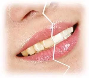 四环素牙的病因有哪些?四大方法预防四环素牙