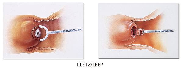 LEEP刀治疗女性宫颈糜烂的优点有哪些?LEEP刀手术会有后遗症吗?