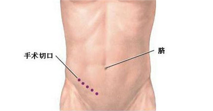 患急性阑尾炎的危害 急性阑尾炎穿孔怎么治疗?