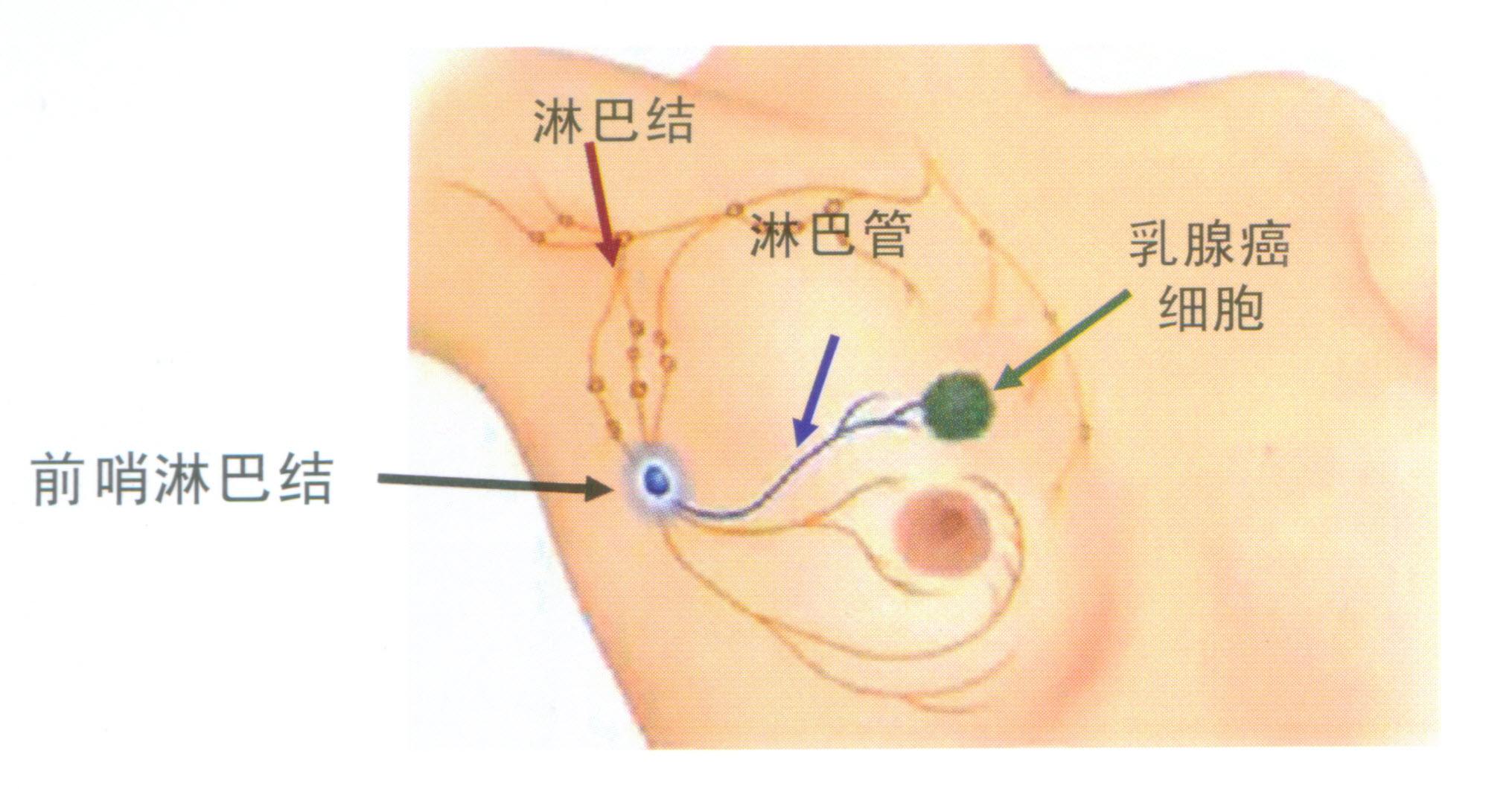 腋窝淋巴结肿大的原因?淋巴结肿大如何治疗?