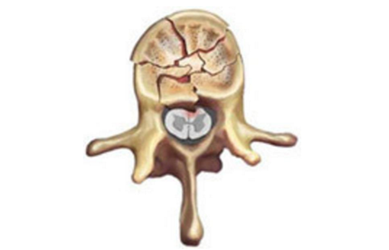 腰椎压缩性骨折有哪些症状?腰椎压缩性骨折治疗方法