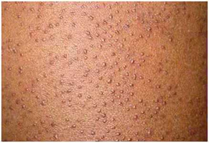 毛孔角化症的病因介绍 毛孔角化症怎么治疗?