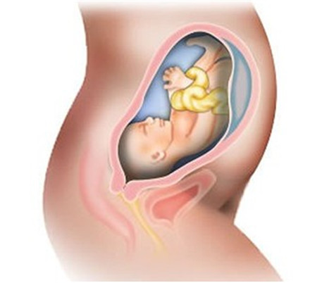 胎粪吸入综合征是怎么引起的?胎粪吸入综合征怎么办?