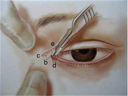 开眼角手术会留下疤痕吗?开眼角手术后遗症有哪些?