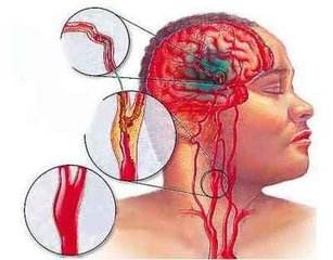 脑血栓的病因有哪些?推荐一些脑血栓的预防方法
