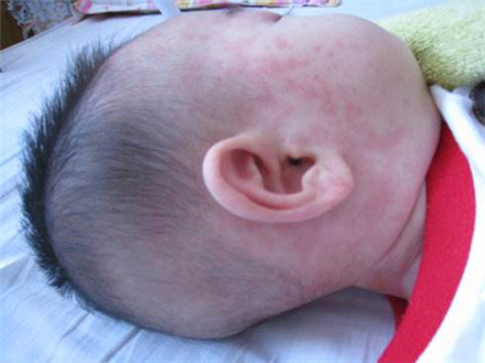 婴幼儿急疹出疹后护理怎么做?注意事项大盘点