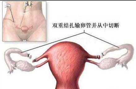 结扎对女性的影响 女性结扎手术后要注意什么?