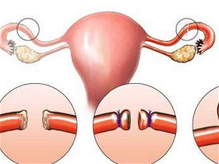 结扎对女性的影响 女性结扎手术后要注意什么?