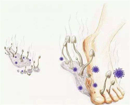 香港脚的症状大全介绍 香港脚为什么要叫香港脚?