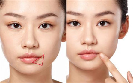 嘴角纹的形成原因 去除嘴角纹的方法有哪些?