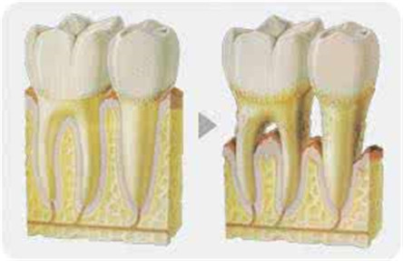 牙龈萎缩的主要原因 牙龈萎缩的治疗方法介绍