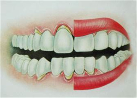 牙龈萎缩的主要原因 牙龈萎缩的治疗方法介绍