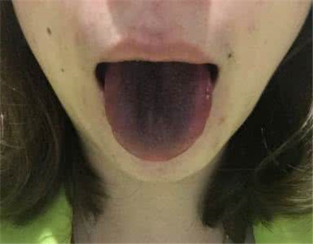 舌头发黑是什么原因?舌头发黑怎么治疗?