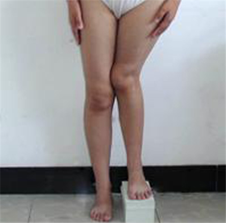 造成长短腿的原因 长短腿怎么矫正?